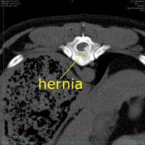 hernia