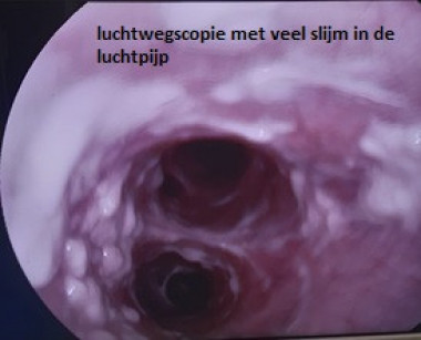 luchtwegscopie 